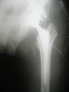 Hips Joints Replacement