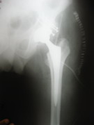 Hips Joints Replacement