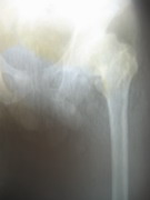 Hips Joints Replacement