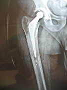 Hips Joints Replacement
