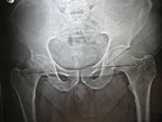 Hips Joints Replacement