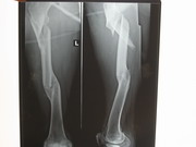 Hips Joints Replacement