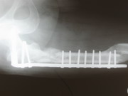 Hips Joints Replacement