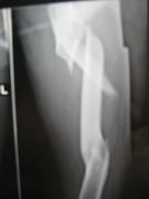 Hips Joints Replacement