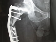 Hips Joints Replacement