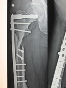Hips Joints Replacement