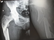 Hips Joints Replacement