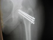Hips Joints Replacement