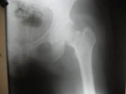Hips Joints Replacement