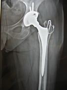 Hips Joints Replacement
