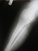 Knee Joint Replacement