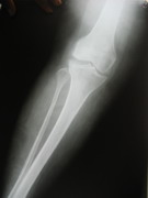 Knee Joint Replacement