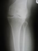 Knee Joint Replacement