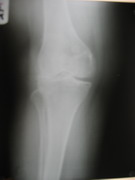 Knee Joint Replacement