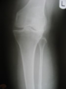 Knee Joint Replacement