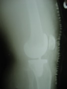 Knee Joint Replacement