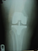Knee Joint Replacement