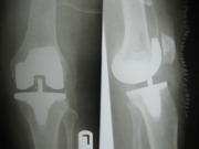 Knee Joint Replacement