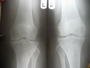 Knee Joint Replacement