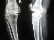 Knee Joint Replacement