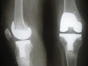 Knee Joint Replacement